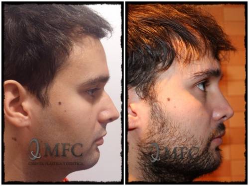 Rinoplastia